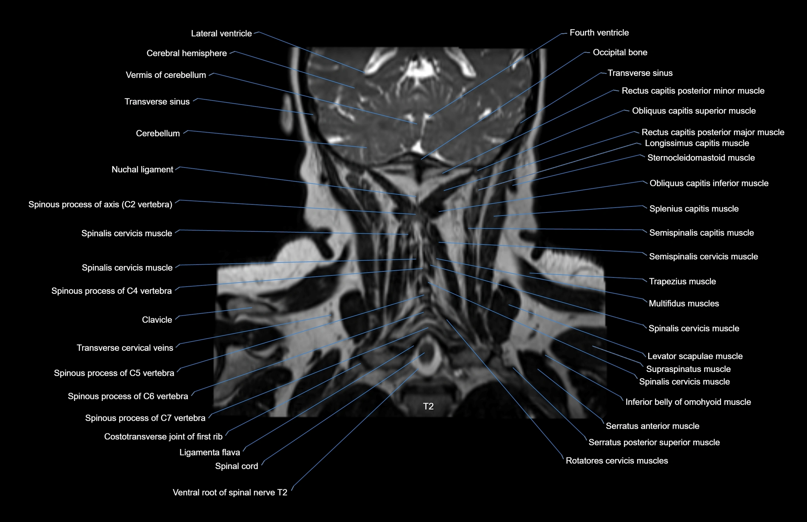 Neck coronal cross sectional MRI anatomy 3T MRI  image-img-00001-00015.webp